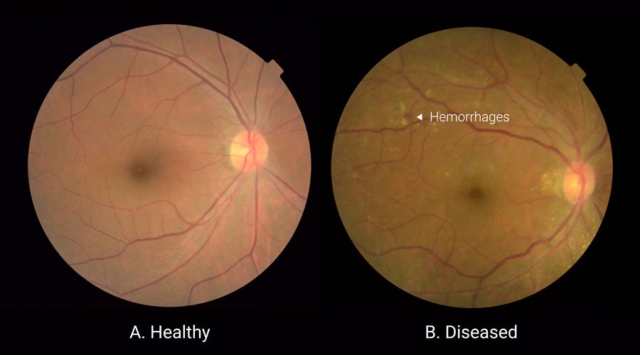 Healthy versus diseased retina scans